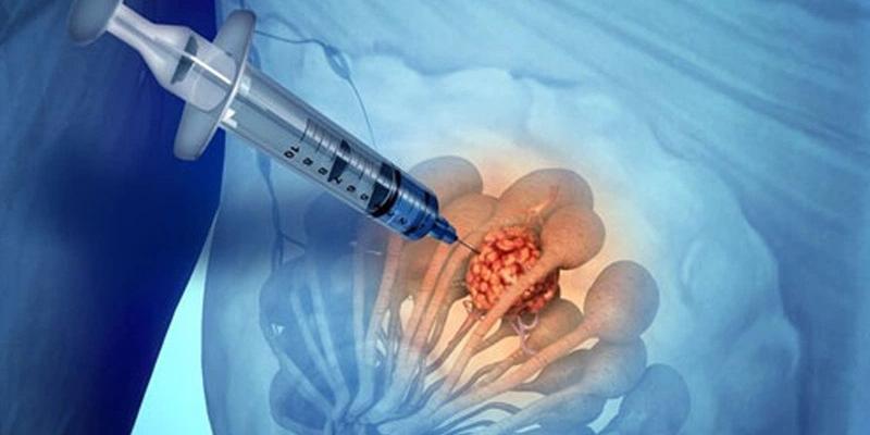 Ghi nhớ những điều quan trọng để thực hiện FNA hiệu quả