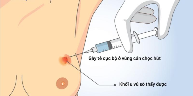 Thủ thuật FNA là thủ thuật chẩn đoán cực quan trọng