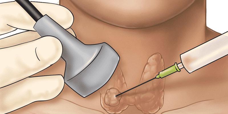 Thủ Thuật FNA - Những Điều Bác Sĩ Chưa Nói Bạn Cần Biết